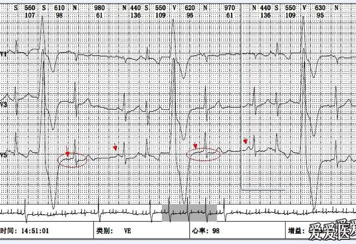 有道理,宽大畸形的qrs波的确像是室性的.