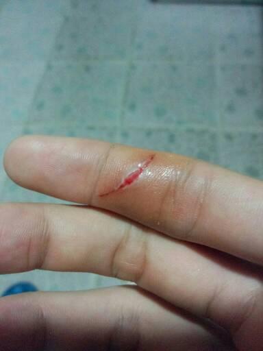 然后用创可贴贴了一天; 现在伤口(不疼不痒不流血); 手指被刀子划了