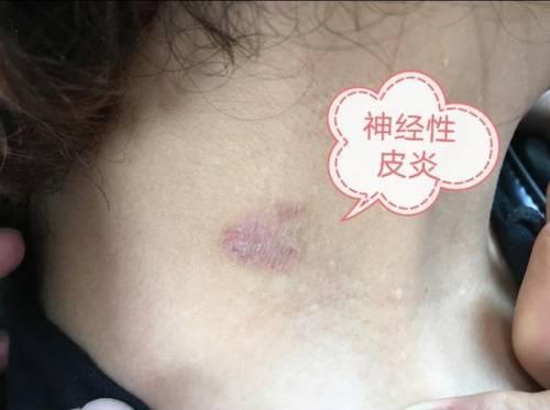 阿拉尔金银川路街道神经性皮炎的治疗阿拉尔金银川路街道银屑病的治疗