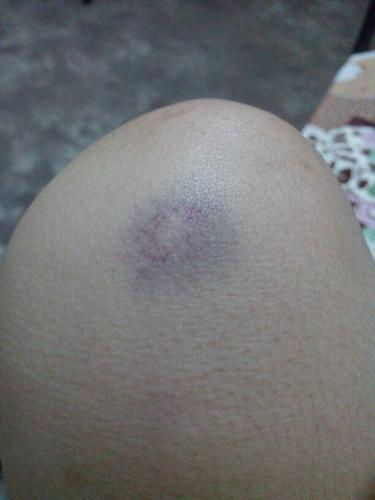 最近一段时间右腿膝盖处老是无缘无故的出现淤青,前几天还是三小快