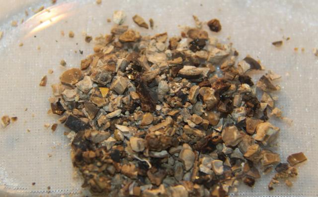 草酸钙结石