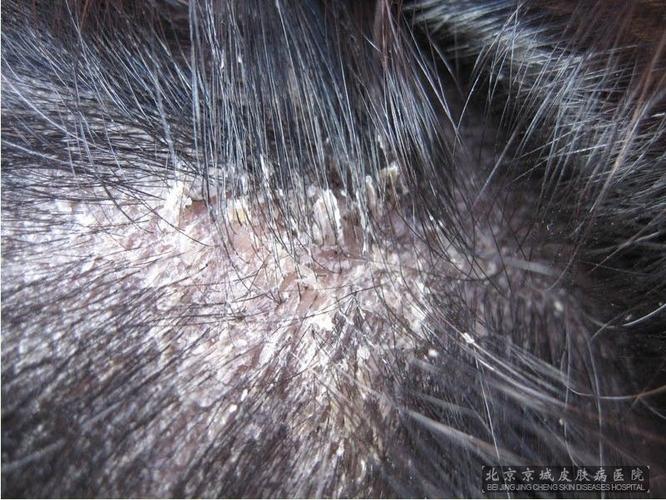 脂溢性皮炎的症状表现都有哪些