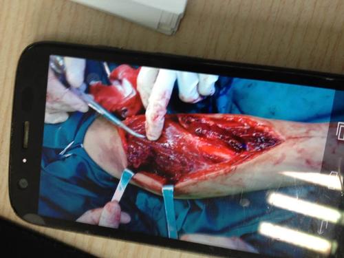 你好,我是工伤,经诊断,左手手臂被机器压到,神经挫伤,肌肉断了五六块.