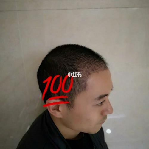 植发一个月,秃头的中年人的蜕变之路!