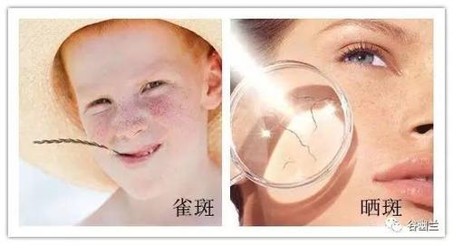 晒斑和雀斑有何不同,夏季如何祛斑?