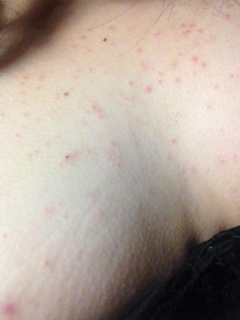 胸前起了一片鸡皮状疙瘩,吃同仁堂皮肤病血毒丸后又起