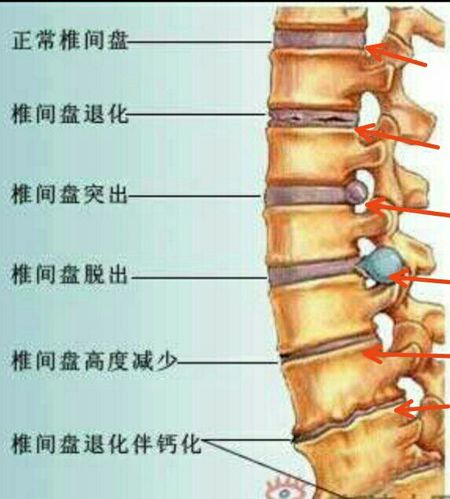 简单介绍硬膜囊受压