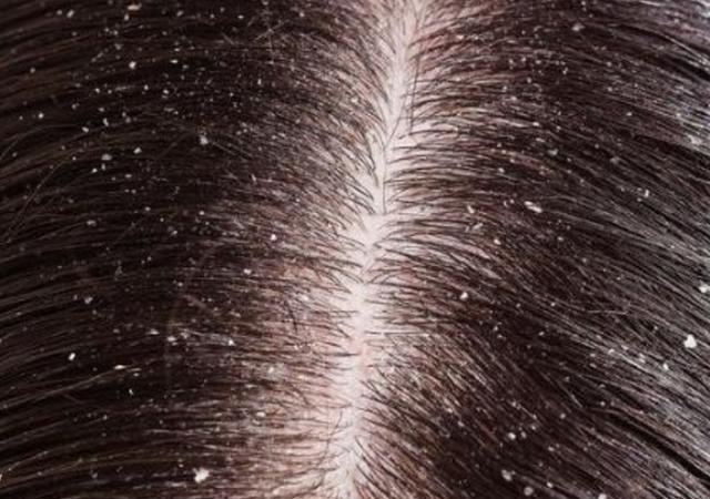 4,头癣 头皮屑的增多