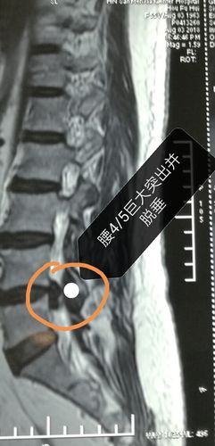 微创孔镜手术治疗腰4/5巨大腰椎间盘突出