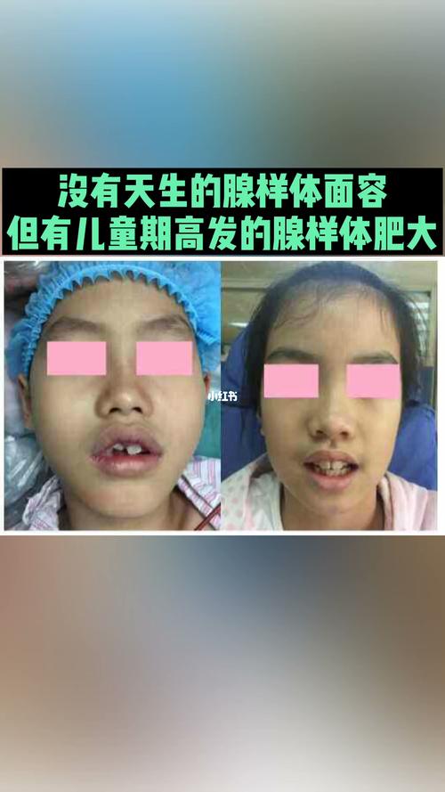 腺样体面容并非天生,但儿童高发腺样体肥大_腺样体肥大_医疗健康_医疗