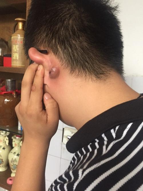 左耳根后部长了一个软包 越来越大,喝酒后很痛,之前长