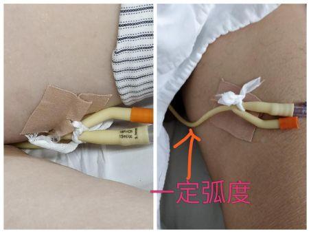 尿管胶布结合绳索固定法,这么好的效果你不看看?