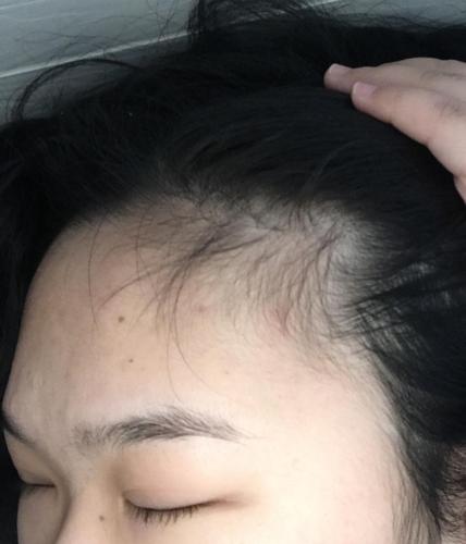 姐妹萌,秃鬓角有必要去看医生吗?