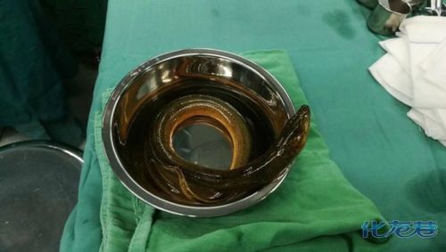常州一游泳爱好者野泳时遭黄鳝从肛门钻肚!      2