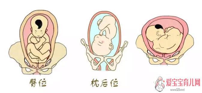 孕晚期胎位不正怎么办孕晚期胎位图