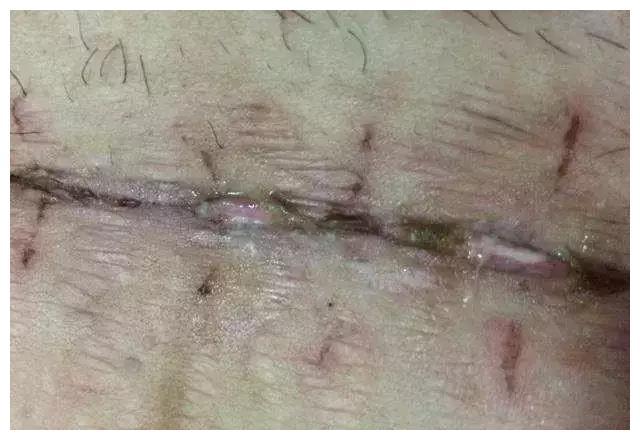 剖腹产后一个月伤口突然发臭流脓水医生检查后怒斥产妇无知