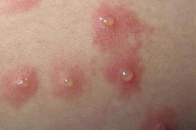 尖锐湿疣的传播途径有哪些呢