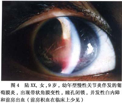 幼年型慢性关节炎及其伴发的葡萄膜炎症状_幼年型慢性关节炎及其伴发