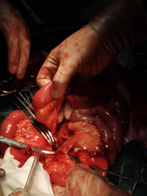 01.16凌晨高空坠落伤肠破裂手术,上午两台腹腔镜