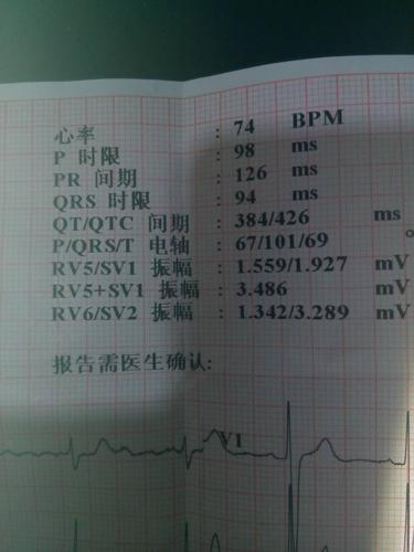 大家看看这个心电图正常吗?有什么小毛病,有参考值吗?