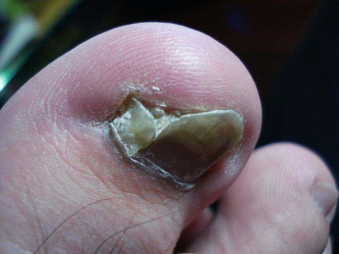 脚趾甲坏了,趾甲下面的肉变硬,然后趾甲要掉,还裂开了