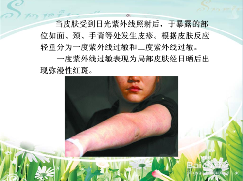 紫外线过敏症状图片