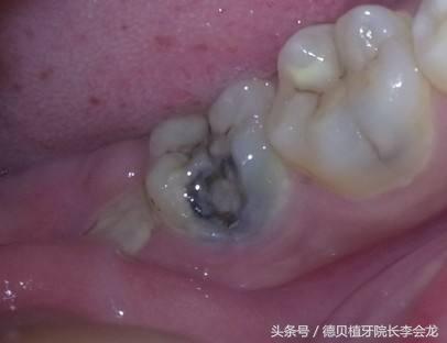 什么样的智齿难拔