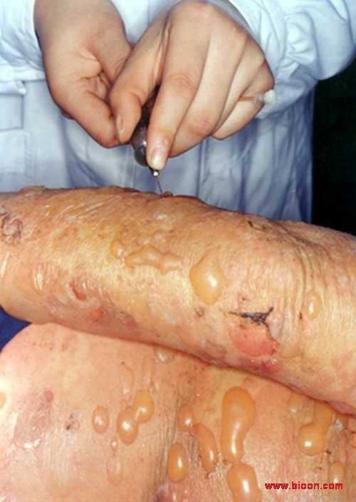大疱性类天疱疮的简介