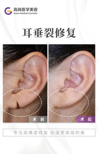 耳垂畸形修复术后耳朵会留疤吗?_耳部整形 - 好大夫在线