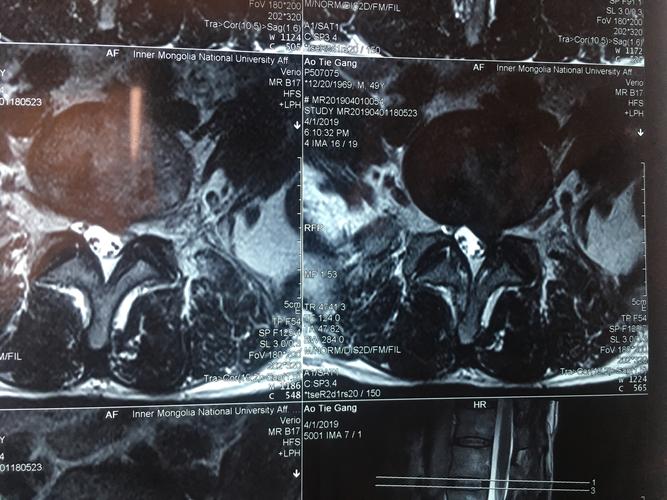 腰5骶1 核磁横断面  纤维环破裂 髓核破入椎管内  直接压迫神经根和