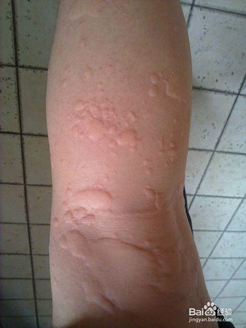 不用吃药,轻松治疗荨麻疹_皮肤科_百度经验