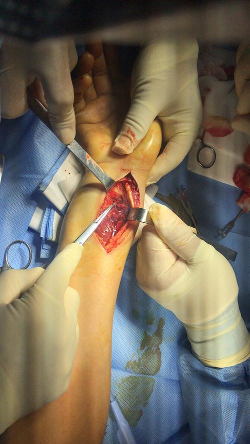 桡骨远端骨折中老年中常见,手法复位外固定还是切开复位内固定,各有