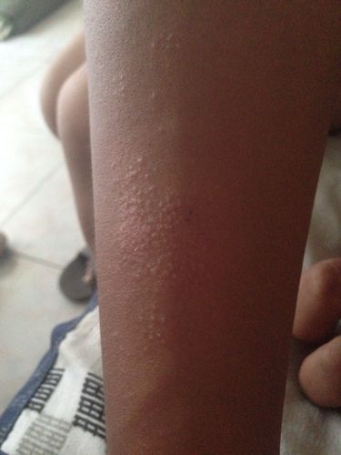 胳膊上长了一片小豆豆,最开始是类似癣的东西,后来开始痒,就挠,然后就