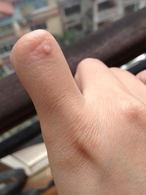 手指上的疙瘩是什么阿?