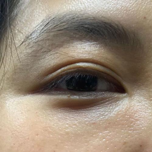 眼周细纹?眼周手针了解一下|鱼尾纹|皱纹_网易订阅