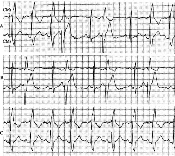 图12-25 室性早搏二联律掩盖右束支阻滞