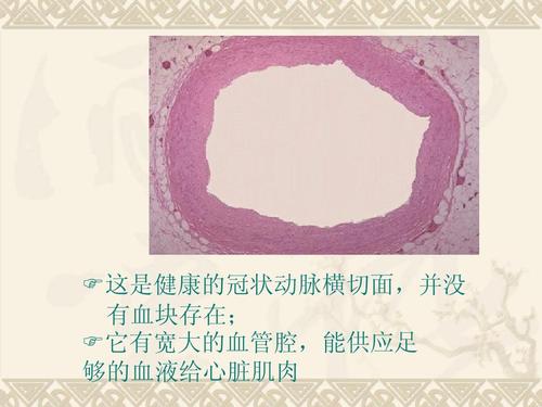 这是健康的冠状动脉横切面,并没 有血块存在;  它有宽大的血管腔,能