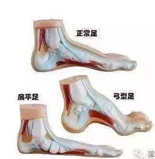 收藏11类常见足跟痛的诊疗要点