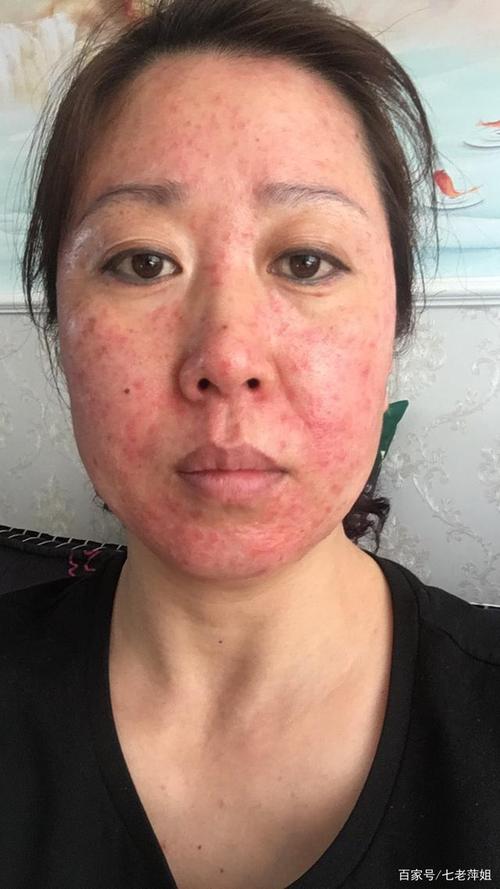 激素脸发红发痒有疹子怎么办?