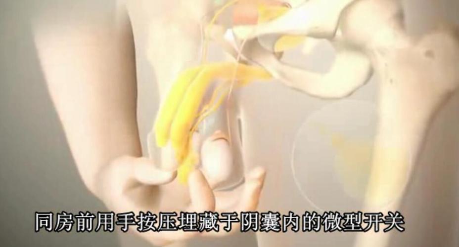 男性功能障碍假体植入能够使用多长时间