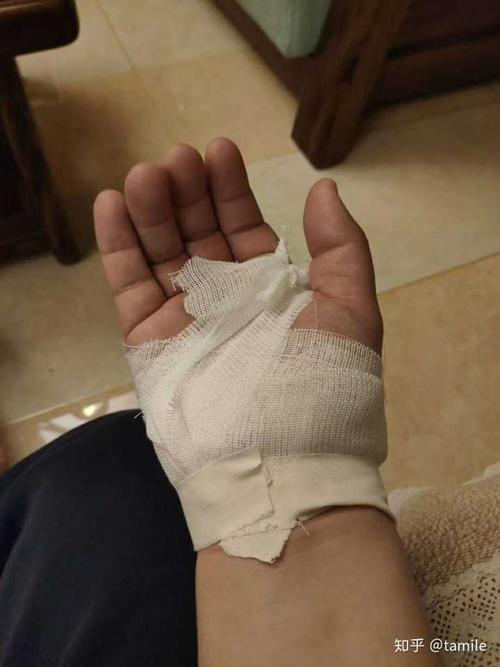 图,当时处理的伤口,靠近手腕位置纱布下就是受伤的皮肤.