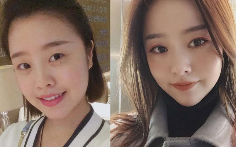 单眼皮女生都很丑吗需要割吗