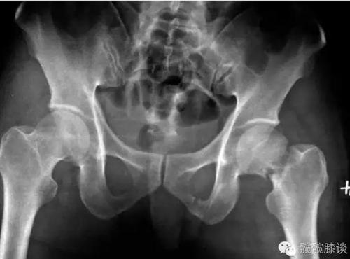 医生解读:股骨颈骨折