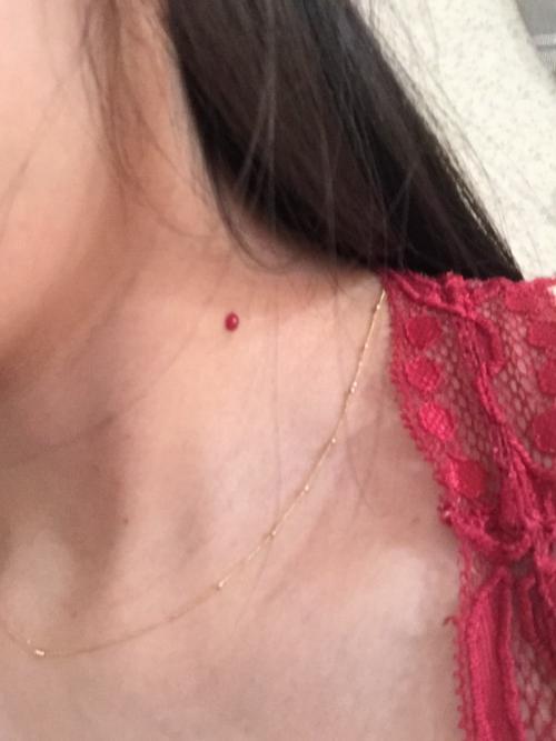 小血包,长速比较快,由小变大,需要治疗吗?是血管瘤吗?