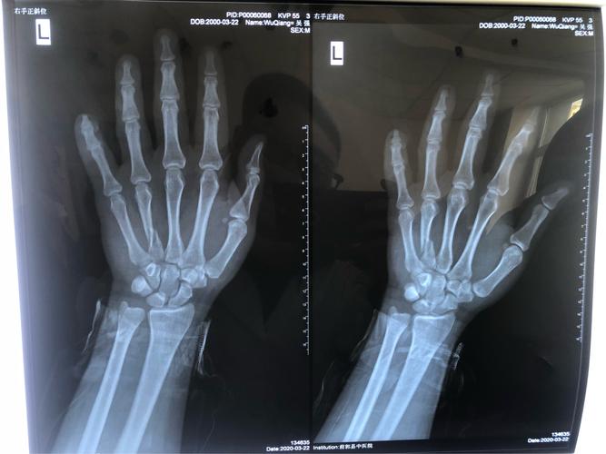 门诊dr片:左手小指末节指骨部分缺如,左手第四掌骨螺旋形骨折,断端