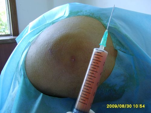 又一例坐骨结节滑囊炎?