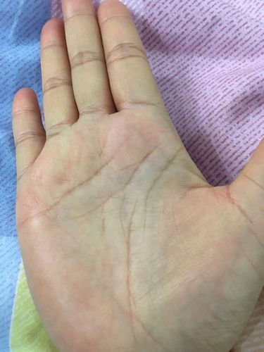 我的生命线中断后分叉是什么意思,请哪位大神解答下,非常感谢!