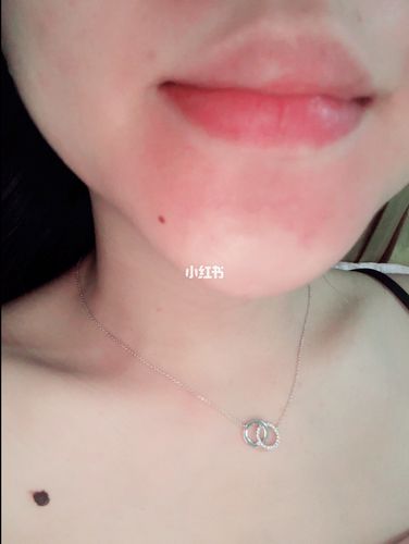 有没有孕期的美妈和我一样的96 嘴巴周围一圈都掉皮