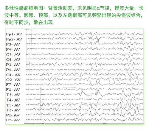 癫痫病各种脑电图波形解答