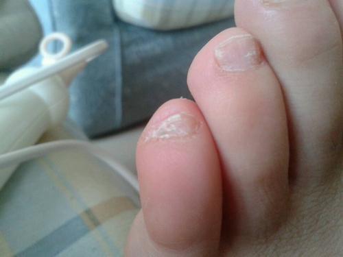 白色表浅型灰指甲要用什么外用药呢?有什么办法,要到医院看么?